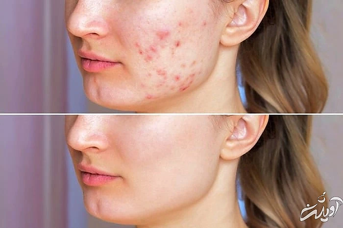 سیب زمینی و تاثیر آن برای از بین بردن جوش های صورت سیب زمینی برای جوش